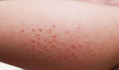 Manifestations externes de la présence de parasites dans l'organisme